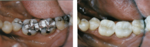 dental caries - before and after